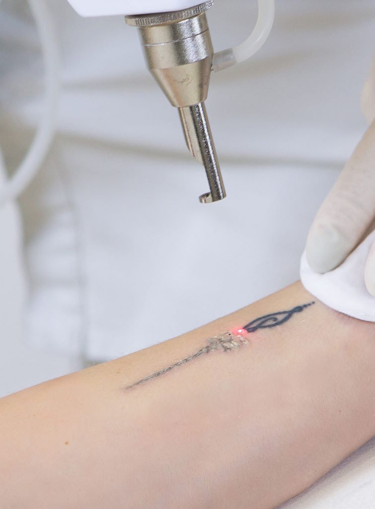 eliminación de tatuajes con laser